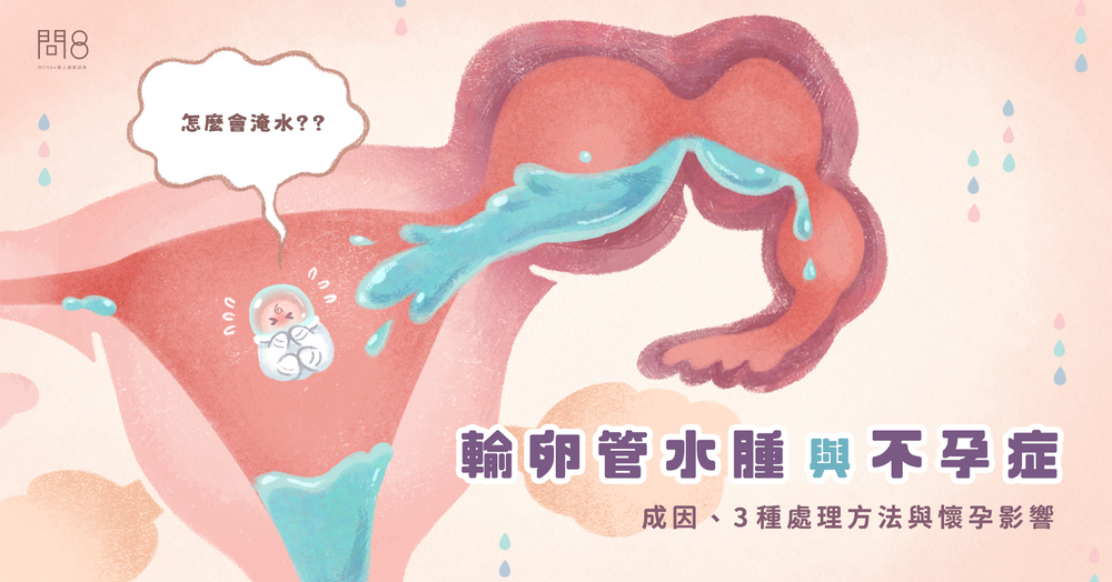 輸卵管水腫與不孕症|成因、3 種處理方法與懷孕影響